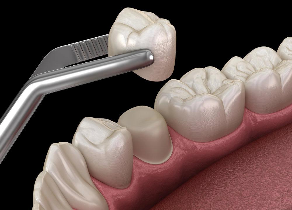 Image depicting a crown replacement for damaged tooth