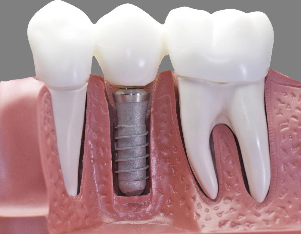 image showing a dental implant
