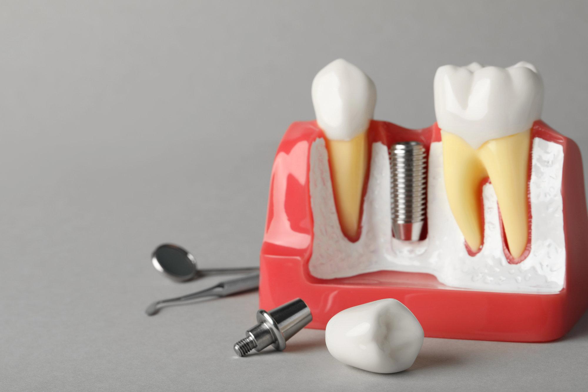 Dental Implants for Front Teeth vs. Back Teeth: What’s Different