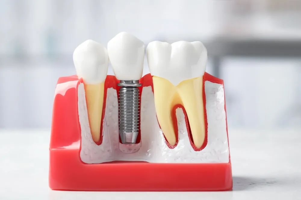 Infographic depicting and cut-away showing a dental implant placement