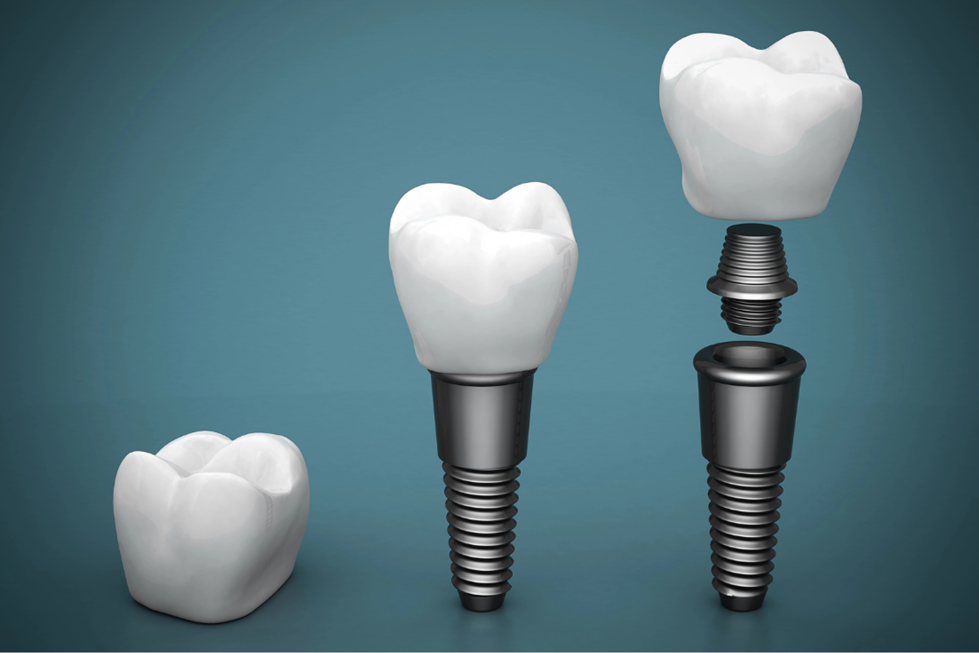Diagram of dental implants and titanium posts