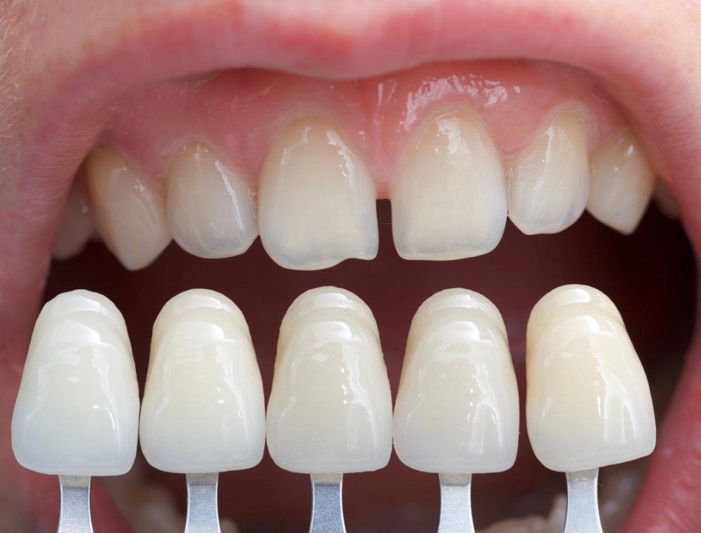Por qué las carillas de aspecto natural están reemplazando la tendencia de la sonrisa perfectamente blanca