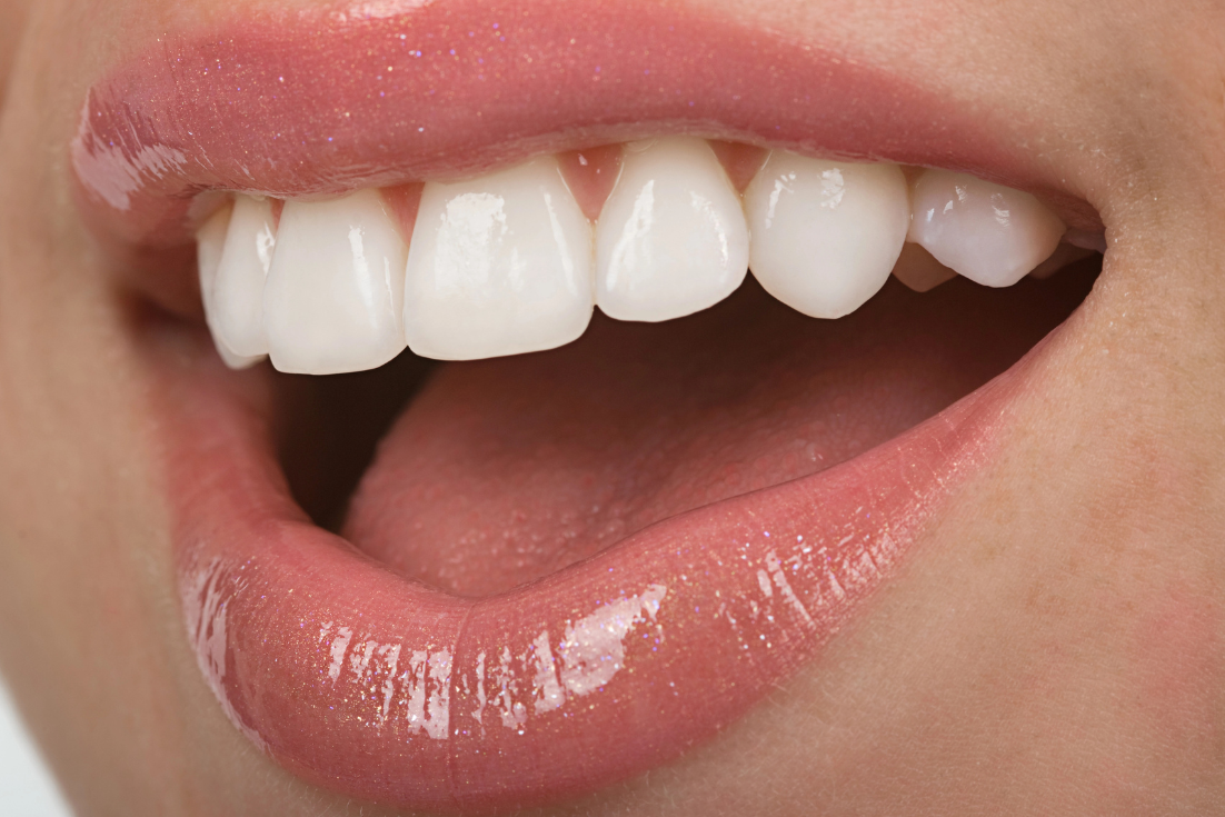 Beautiful smile for dental veneers in Woodland Hills, CA
