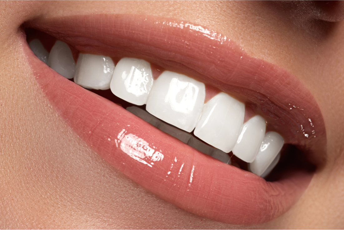 Picture of a nice smile with dental veneers