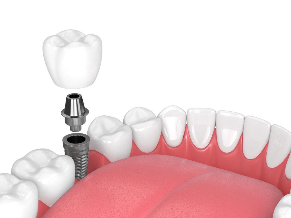 Why Did My Dentist Recommend a Dental Implant Instead of a Crown?